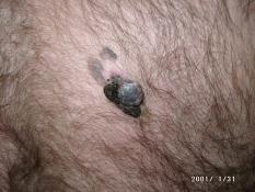 melanoma 2