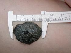 melanoma
